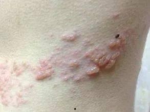 条状疱疹可以吃酥瓜吗,酥瓜是否适宜食用？